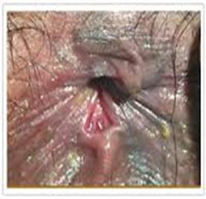 Help Spasm of anus Spasm of anus apologise that